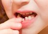 Nằm mơ rụng răng là điềm gì và đánh số nào may mắn nhất Nằm mơ rụng răng là điềm gì và đánh số nào may mắn nhất